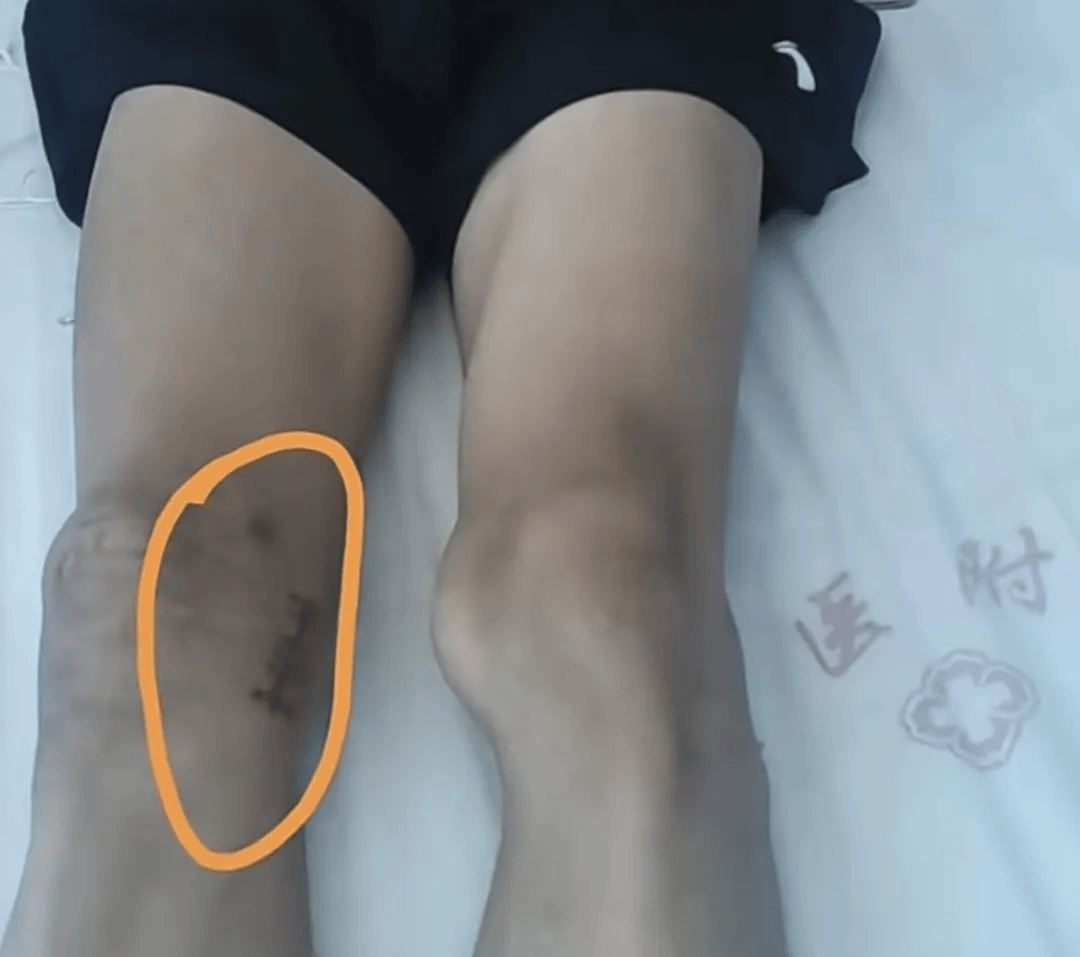 17岁体育生左膝长骨瘤却被错切右膝！母亲：拒绝和解