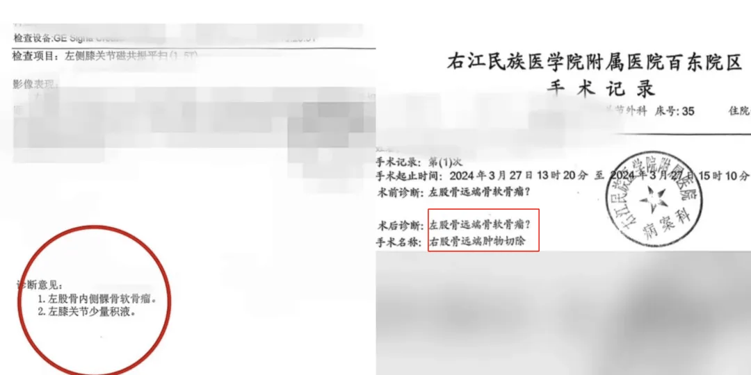 17岁体育生左膝长骨瘤却被错切右膝！母亲：拒绝和解